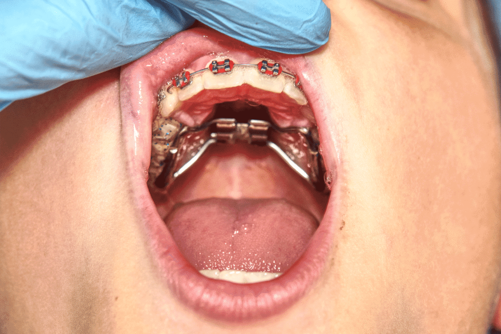 2_expander